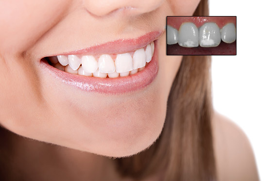 Manchas blancas en los dientes: ¿Por qué aparecen y cómo evitarlas?