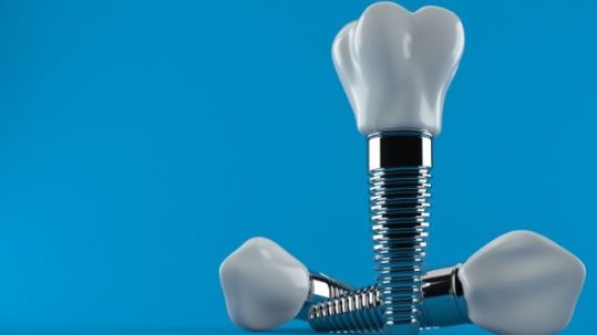 cuanto se tardan en poner los implantes dentales