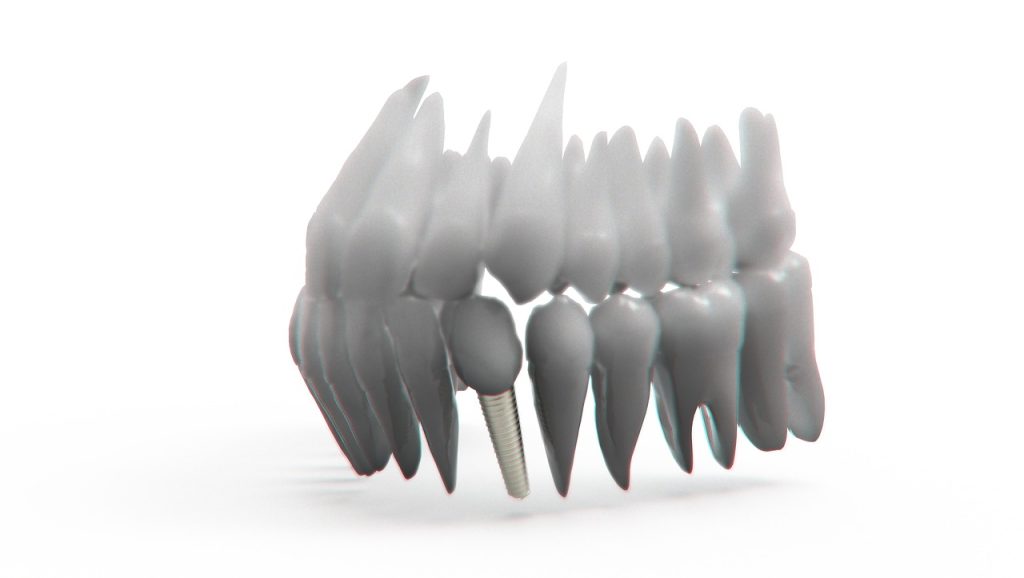 Ortodoncia con implantes