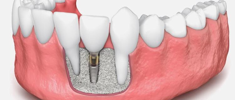 implantes dentales sin hueso