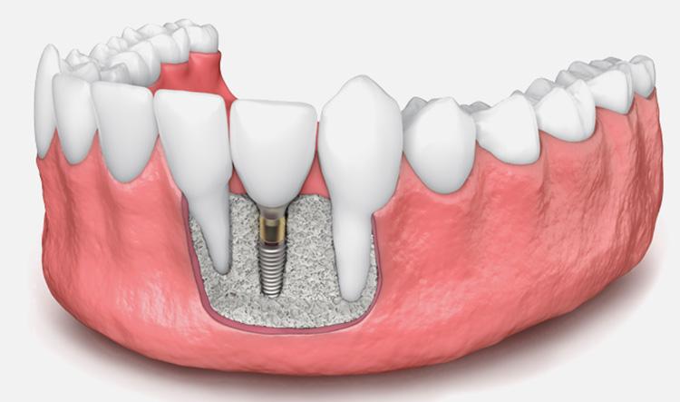 implantes dentales sin hueso